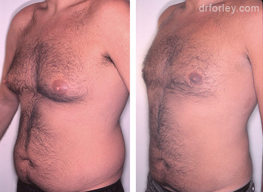 B/A photos: 36 year old male 8 months following gynecomastia surgery of the chest - oblique view