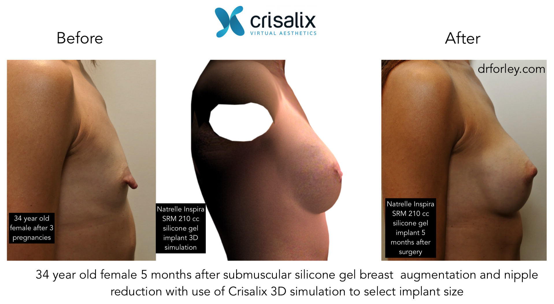 Breast Lift and Cup Size  Los Altos Breast Enhancement