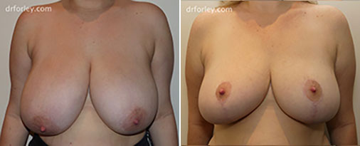 Woman's Breast, Before and After Treatment photo, front view, patient 1