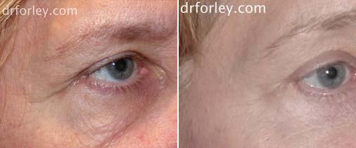 Patient face, before and after Eyes treatment, oblique view