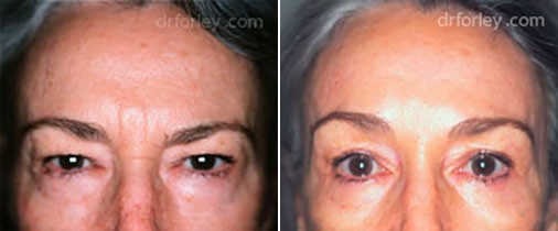 Woman's face, before and after Nose Surgery Treatment, female nose patient 1