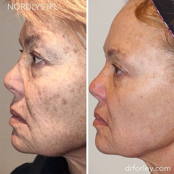 Female face, before and after Nordlys IPL treatment, side view, patient