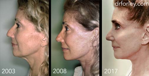 Facelift Photo: Woman's face in 2003/2008/2017 years, After Treatment, left view