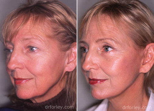 Facelift Photo: Woman's face After Treatment, oblique left view, patient 1