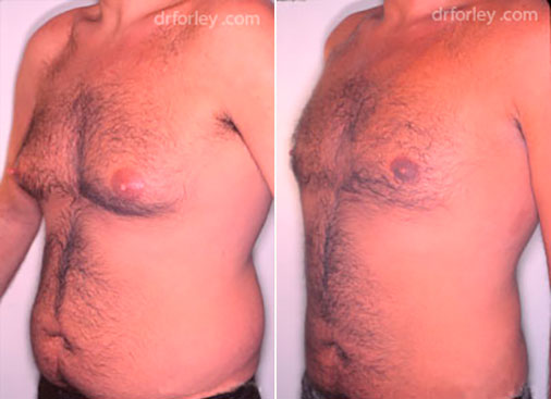 Male body, before and after liposuction treatment, oblique view, patient 1