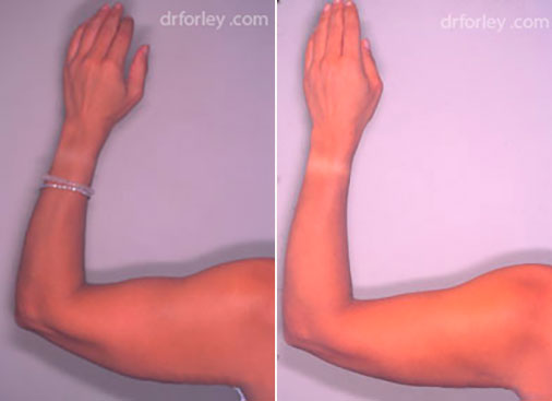 Woman's hand, before and after liposuction treatment, back view, patient 2