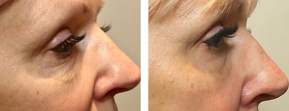 Female face, before and after Morpheus8 treatment, right side view