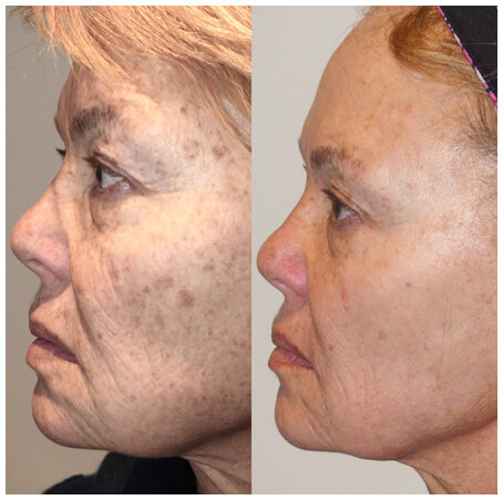 Woman's Face, Before and After using the Nordlys system, side view