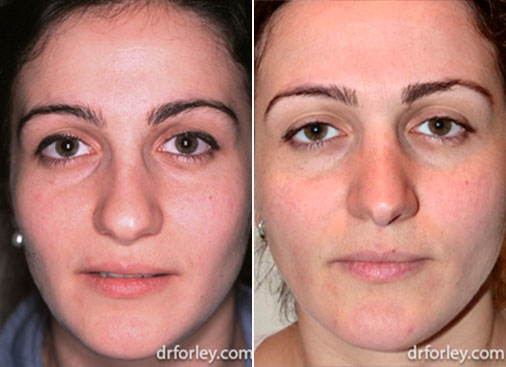 Woman's face, before and after Nose Surgery Treatment, female nose, patient 1