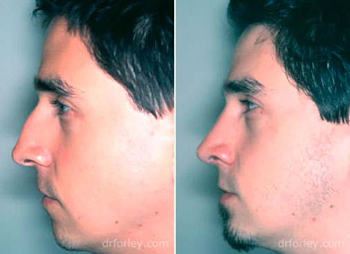 Male face, before and after Nose Surgery Treatment, male nose, side view, patient 2