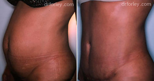 Female TUMMY TUCK, Before and After treatment photo, oblique view, patient 1