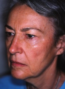 IMG - Version 2 71 year old female prior to facelift, browlift, upper and lower eyelid surgery.