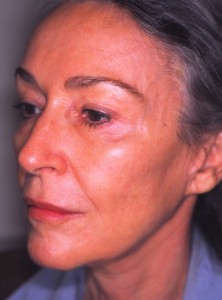 IMG0001 - Version 2 3 years following surgery