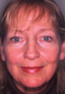 Raejean 1 - Version 2 58 year old female prior to facelift and upper and lower eyelid surgery.