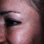 BOTOX® After treatment with 