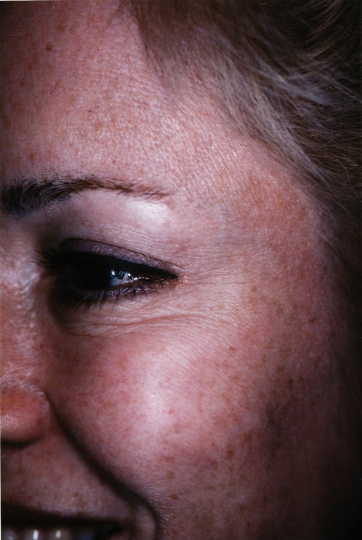 Woman's patient face, after Injectable Fillers treatment, oblique view