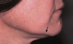 Early aging changes along jawline