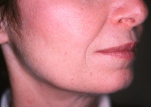 Before treatment with Sculptra®Aesthetic