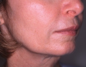 After treatment with Sculptra®Aesthetic