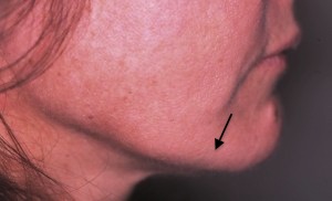 Restoration of jawline definition by adding volume