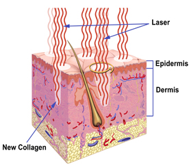 Blog - LASERS EXPLAINED Photo LASERS EXPLAINED