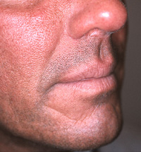 Blog - COSMETIC PROCEDURES FOR MEN Photo Male face, before Non Surgery Treatment, male nose, side view, patient 1