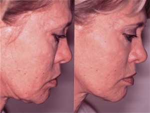 Blog - MY SAGGING NECK: WHAT ARE MY OPTIONS? Photo Before and 1 Month After Ultherapy of Face & Neck