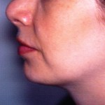 After Liposuction of Neck