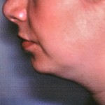 Before Liposuction of Neck