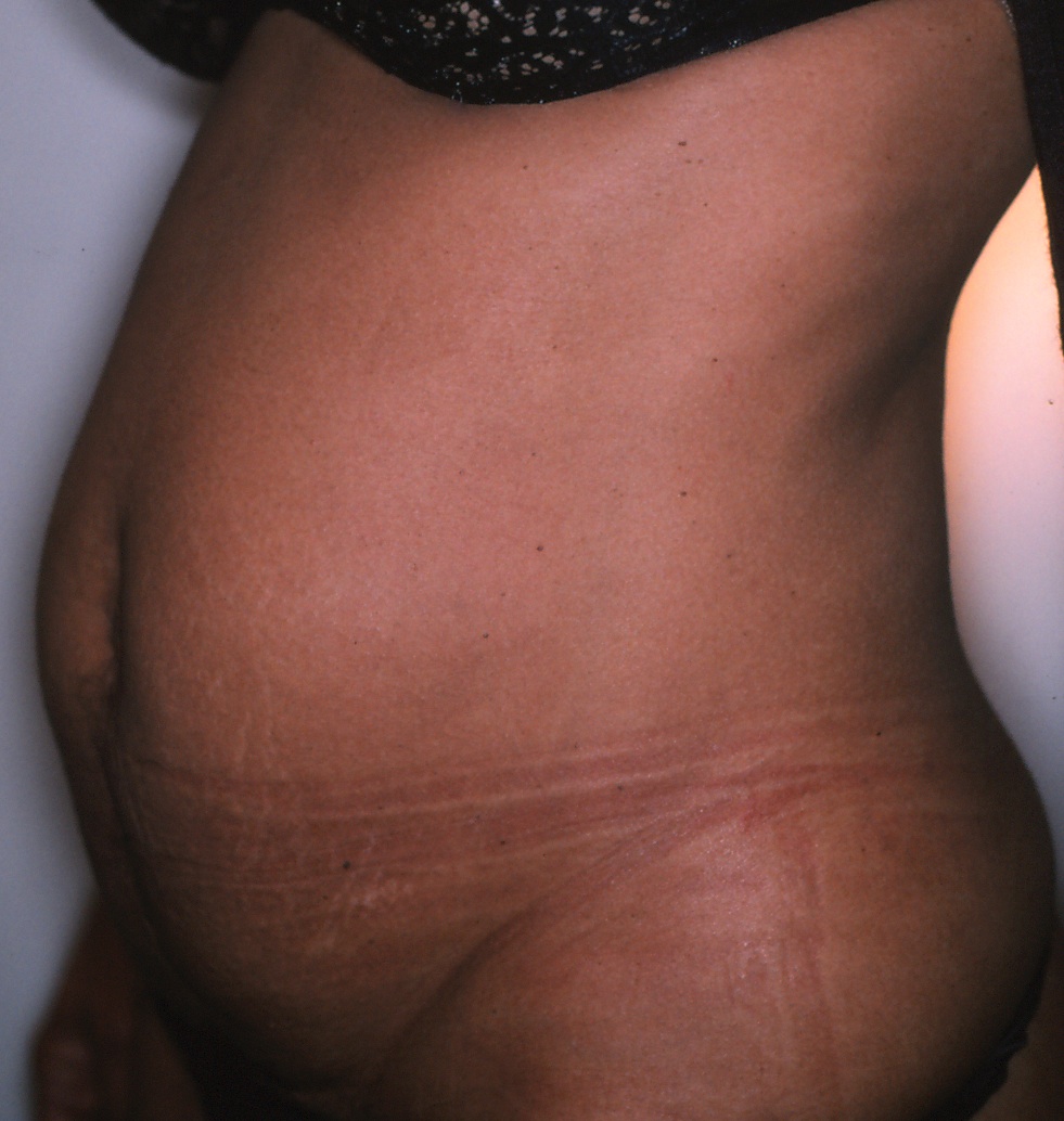 Blog - TUMMY TUCK OR LIPOSUCTION: WHICH ONE IS RIGHT FOR ME? Photo Female TUMMY TUCK, Before treatment photo, oblique view