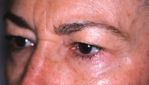 Before Endoscopic Browlift