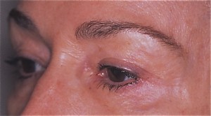 After Endoscopic Browlift