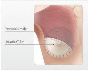 ENHANCING BREAST SURGERY RESULTS WITH STRATTICE™