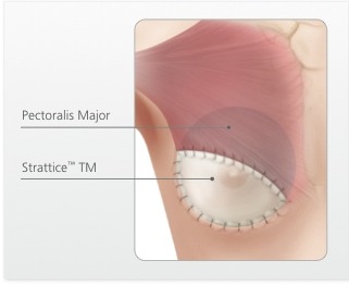 PART 1: ENHANCING BREAST SURGERY RESULTS WITH STRATTICE