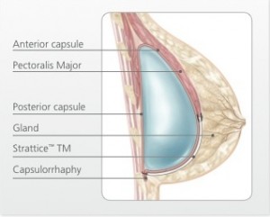 BREAST SURGERY RESULTS WITH STRATTICE™