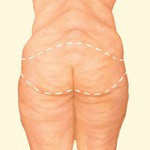 BODY CONTOURING BEFORE WEIGHT LOSS SURGERY