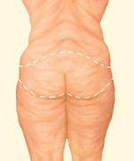 BODY CONTOURING AFTER WEIGHT LOSS SURGERY (back view)