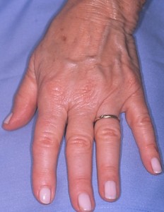 Before - HAND REJUVENATION