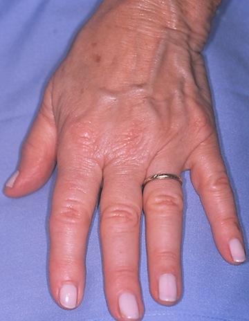 Blog - -HAND REJUVENATION Photo 