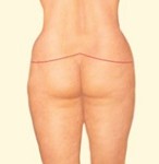 BODY CONTOURING AFTER WEIGHT LOSS SURGERY