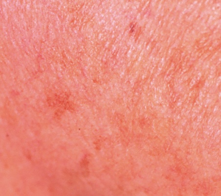 Blog - AGE SPOTS: A TREATMENT STRATEGY Photo 