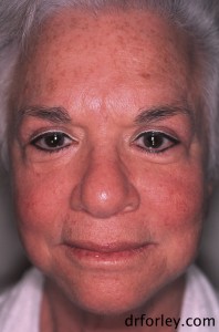 68 year old female before treatment