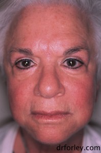 68 year old female 7 months following Fraxel®