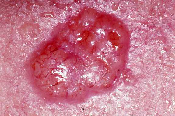 Squamous Cell Carcinoma