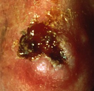 Basal Cell Carcinoma