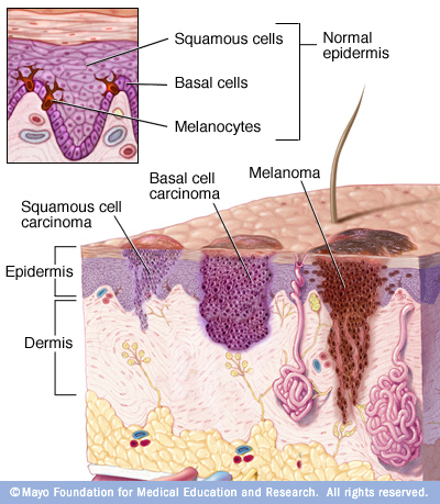 Blog - SKIN CANCER: WHAT YOU NEED TO KNOW Photo SKIN CANCER: WHAT YOU NEED TO KNOW