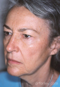 Blog - FACELIFTS: THE WIND TUNNEL MYTH Photo Woman's face Before Facelift treatment, oblique view, patient 5