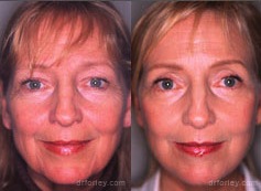 Before & After  FACELIFTS