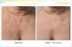 Before & After ultherapy 180days