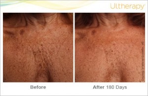 Before & After 180days ultherapy